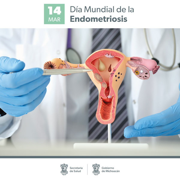 Menstruación dolorosa o infertilidad, sintomas de endometriosis