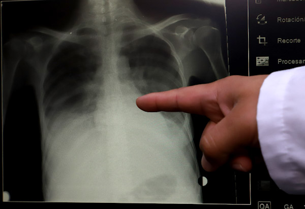 SSM ofrece atención oportuna de tuberculosis