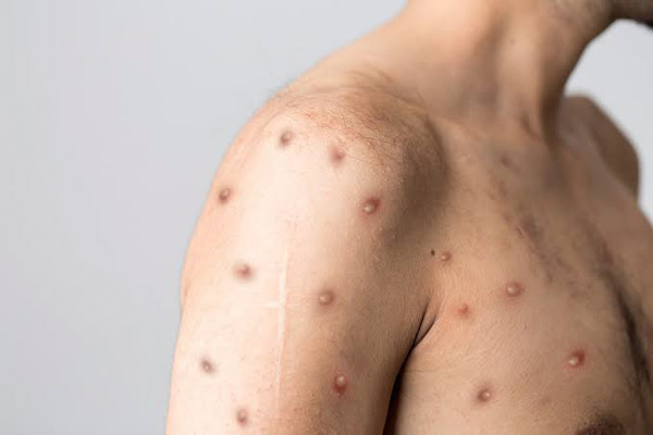 Piden mantener prevención de contagios de viruela símica