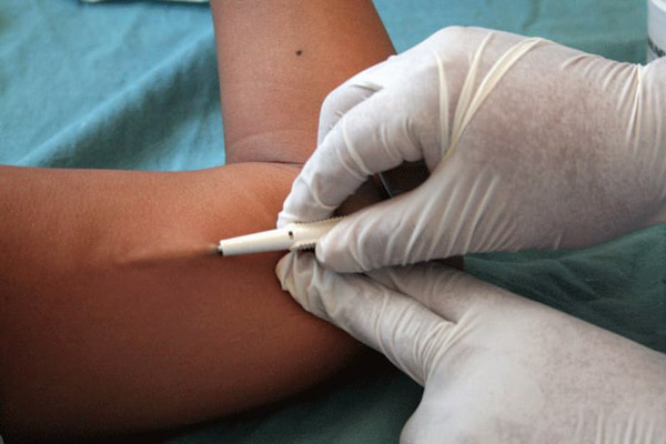 Aplican implantes subdérmicos para para prevenir embarazos