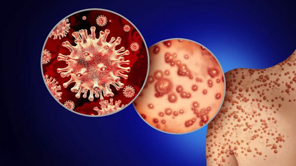 Suecia confirma un primer caso de mpox fuera de África